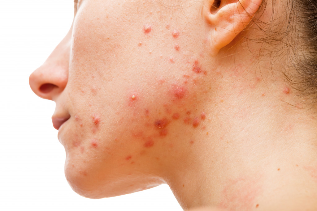 A person with acne on the jawline because of a disorder